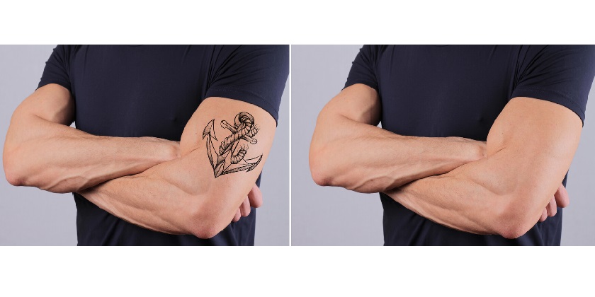 Laser Tattoo Removal Atlanta | Tattoo Removal Benefits, Recovery, Results