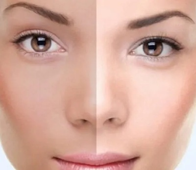 Glutathione - Skin Whitening